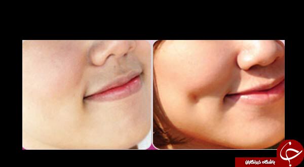 مد این روزها، جراحی چال گونه+تصاویر